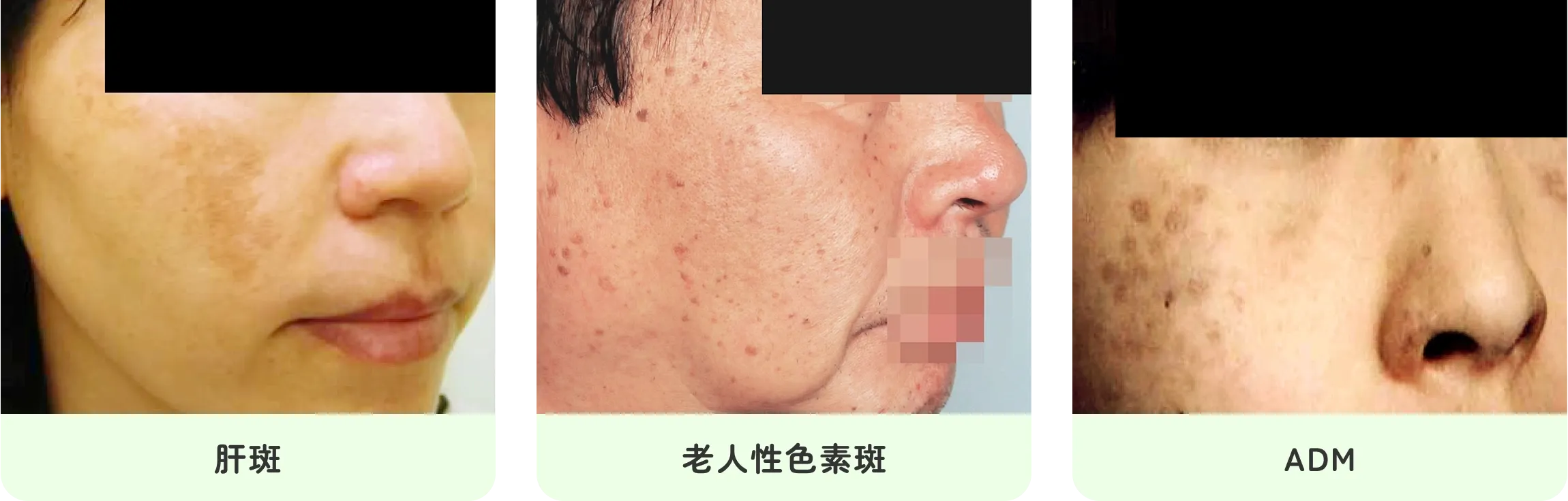 肝斑,老人性色素斑,ADM