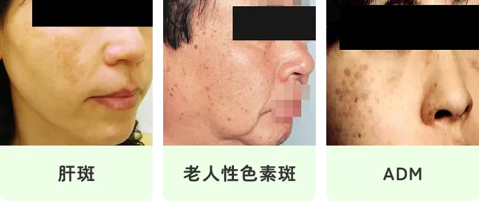 肝斑,老人性色素斑,ADM